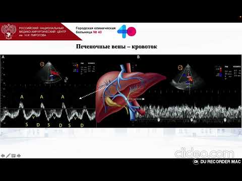 Видео: VExUS   возможные ошибки и ловушки метода