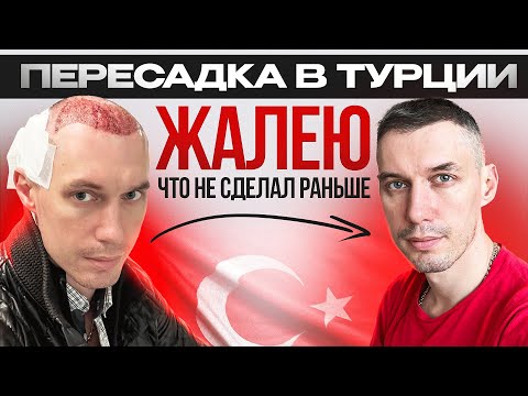 Видео: ПЕРЕСАДКА ВОЛОС В ТУРЦИИ, ЖАЛЕЮ, что не сделал раньше, 4 мес после пересадки. Ответы на вопросы.