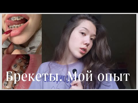 Видео: я установила брекеты. мой опыт и ощущения | зилич