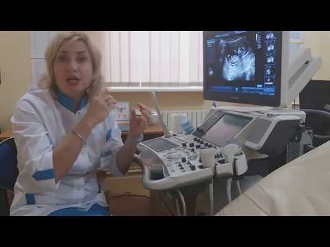 Видео: Рубец на матке после кесаревого сечения при последующей беременности