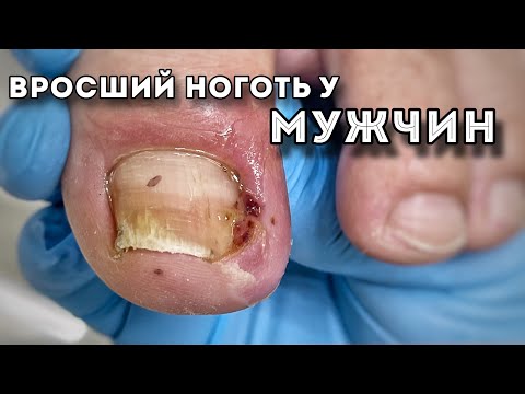 Видео: Первая помощь при врастании ногтя у мужчин