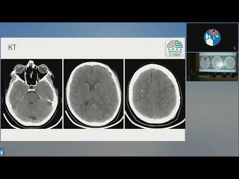 Видео: ВЧД и диаметр зрительного нерва Мурадян К.Р.