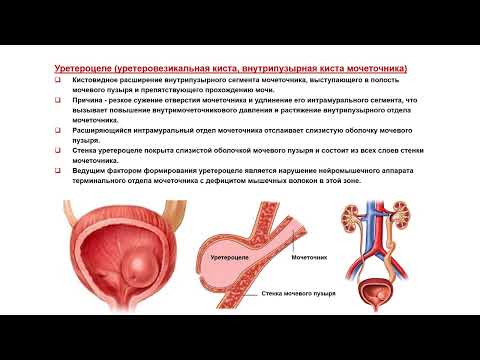 Видео: Ультразвуковая диагностика. Доктор Иогансен. Выпуск 95. Аномалии развития мочевого пузыря. Часть 1.
