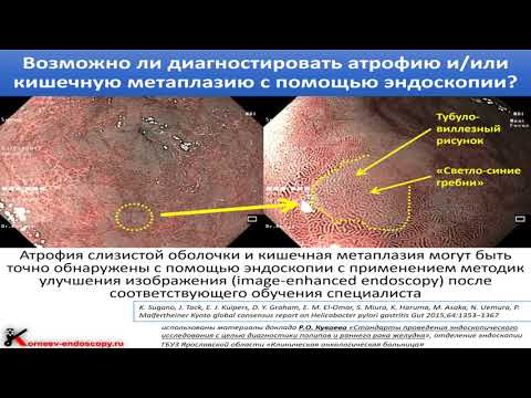 Видео: 10 Корнеев АА Эндоскопия раннего рака желудка  Как не пропускать ранний рак
