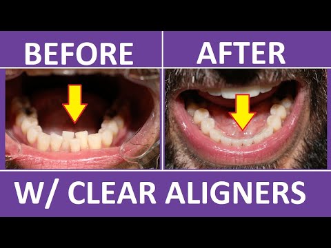 Видео: Брекеты Invisalign до и после: неправильный прикус, скученность зубов: стоимость, боль, советы. П...