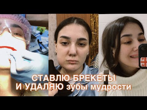 Видео: Я ПОСТАВИЛА БРЕКЕТЫ 😍