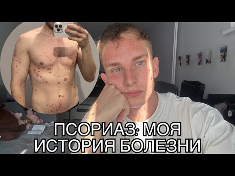 Видео: Как я лечился от ПСОРИАЗА | Моя история болезни