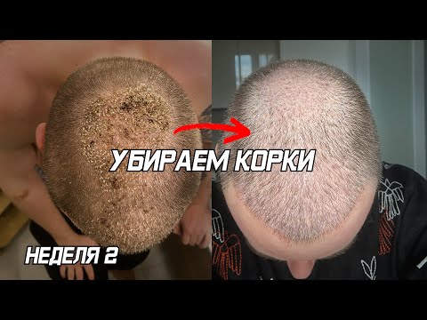 Видео: Отмываем корки, вторая неделя после пересадки волос
