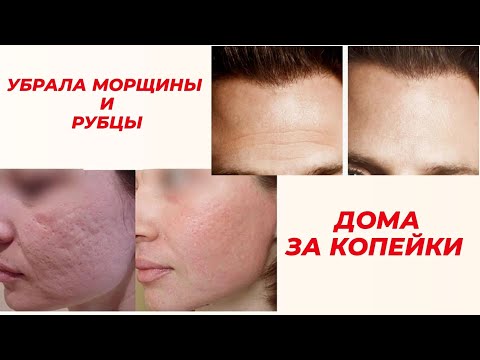 Видео: как я избавилась от МОРЩИН и РУБЦОВ / МЕЗОТЕРАПИЯ ДОМА