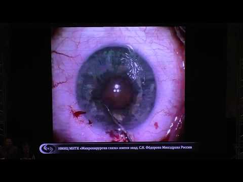Видео: Узкий зрачок в хирургии катаракты