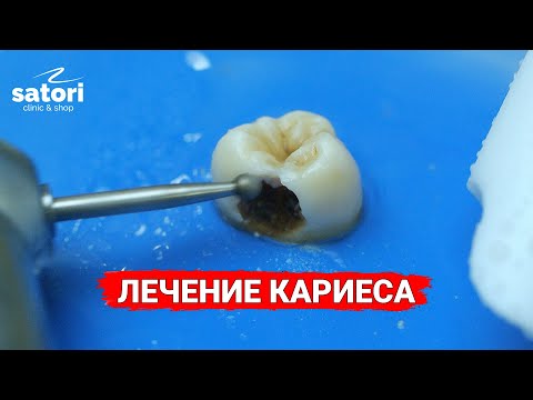 Видео: Процесс лечения кариеса