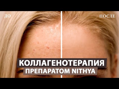 Видео: Улучшаем качество кожи лица с помощью коллагена «Nithya» (Нития)
