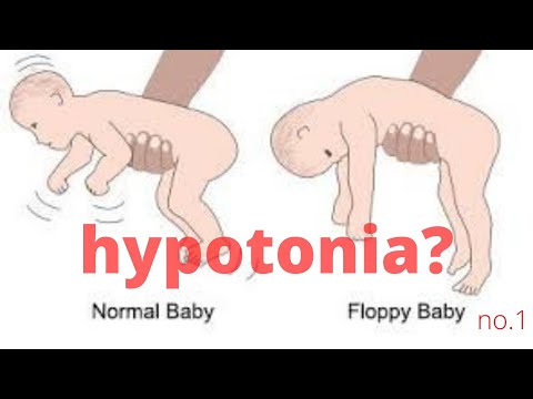 Видео: Гипотония и тетраплегия / Как улучшить двигательные паттерны? / Часть 1