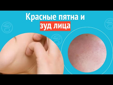Видео: 😯 Красные пятна и зуд лица. Клинический случай №1126
