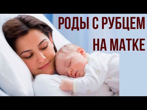 Видео: Роды с рубцом на матке. Кесарево сечение