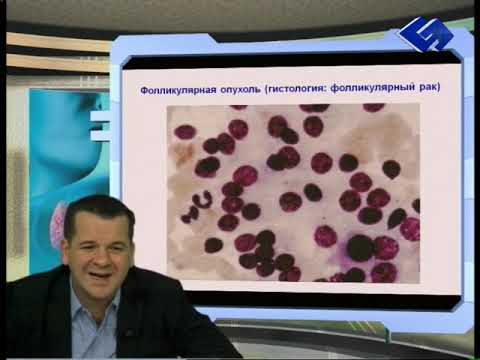 Видео: Просто об узловом зобе (2012 год) - Часть 3