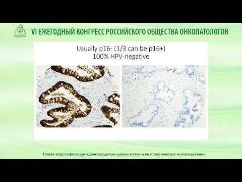 Видео: Новая классификация аденокарцином шейки матки и ее практическое использование