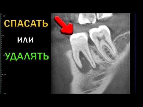 Видео: Последствия хронического периодонтита зуба с деструкцией бифуркации и его лечение. Исход лечения