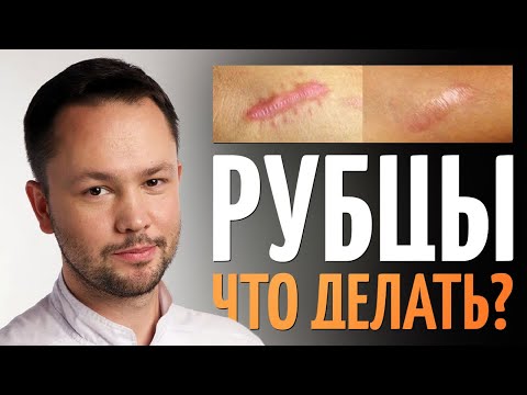 Видео: Шрамы (Рубцы). Как избавиться? Обзор методов от врача косметолога.