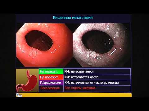 Видео: 04 Федоров ЕД   Киотская классификация гастритов