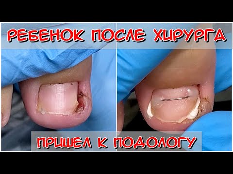Видео: Ребенок после хирурга пришел к подологу / Вросший ноготь на ноге / Вросший ноготь на ноге что делать