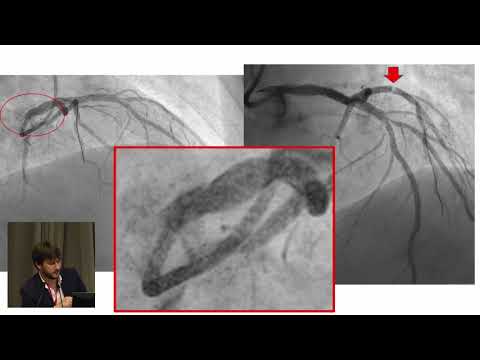 Видео: Д.В. Скрыпник. Роль внутрикоронарной визуализации в лечении ИБС.