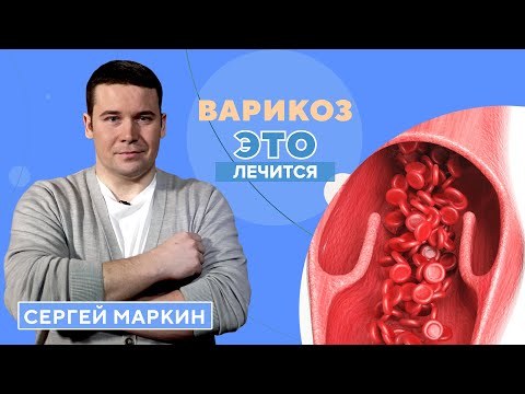 Видео: Все о варикозе: виды, профилактика, эффективные методы лечения