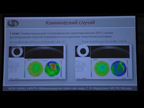 Видео: Помутнение роговицы + смешанный астигматизм