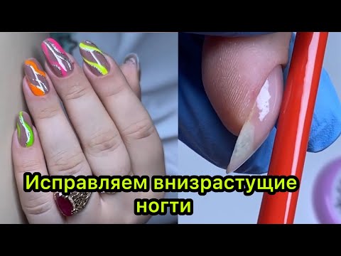 Видео: Исправляем внизрастущие ногти