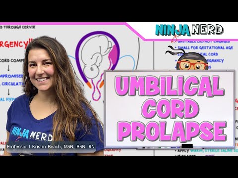 Видео: Выпадение пуповины