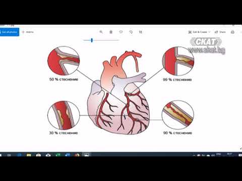 Видео: Академия "Здравословно": Исхемична (коронарна) болест на сърцето