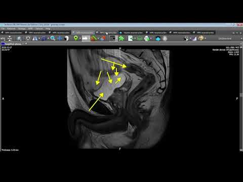 Видео: Внутренние грыжи и простатит. Или, Простатит и внутренние грыжи.