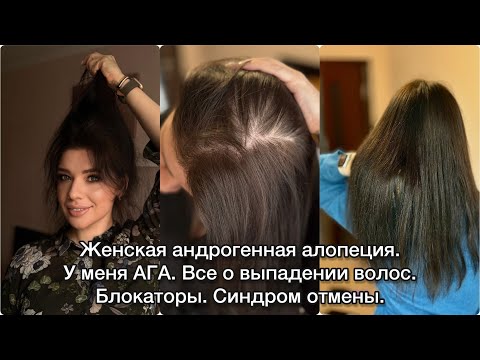 Видео: БЛОКАТОРЫ ПРИ АЛОПЕЦИИ. ВЫПАДЕНИЕ ВОЛОС. ОТ ЧЕГО ВЫПАДАЮТ ВОЛОСЫ? АГА. ВИБРОЗ. ДИФФУЗНОЕ ВЫПАДЕНИЕ 