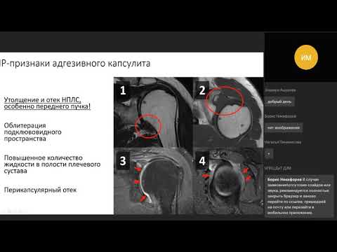 Видео: Аксиллярный карман: забытая область в МРТ плечевого сустава