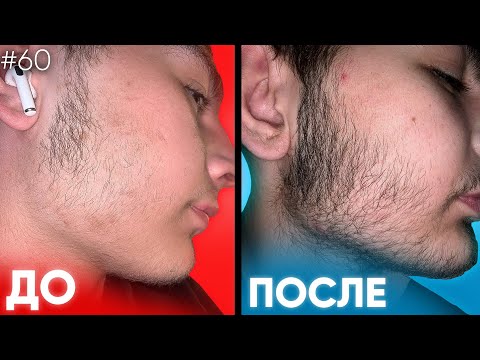 Видео: ПУХ ПРЕВРАТИЛ В БОРОДУ! Результаты ксиноксина за 4 месяца