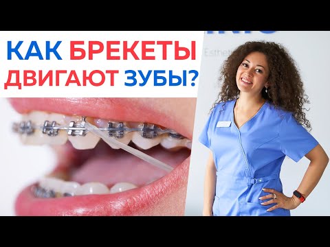 Видео: Ретейнеры и капы после брекетов. Что лучше? / Как происходит движение зуба?