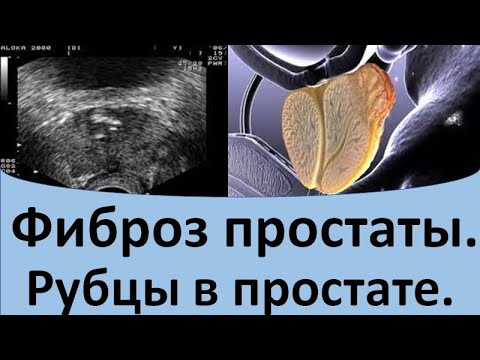 Видео: Фиброз простаты. Рубцы в простате.
