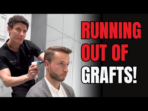 Видео: Сколько графтов осталось после моих трех FUE?