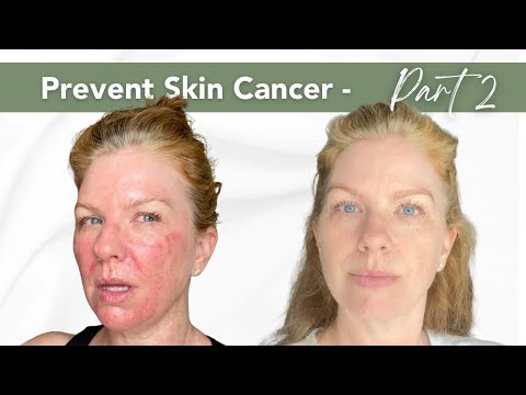 Видео: Фотодинамическая терапия (ФДТ) – краткий обзор | Профилактика рака кожи и лечение актинического к...