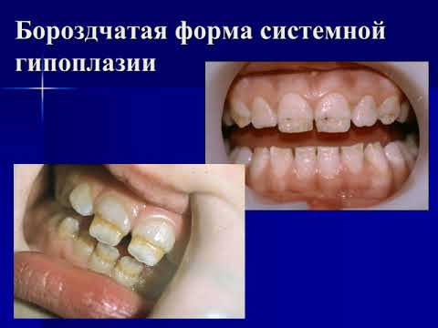 Видео: Пороки развития твердых тканей зубов у детей