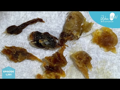 Видео: 1351 пациент с оглушающими пробками из омертвевшей кожи в обоих ушах