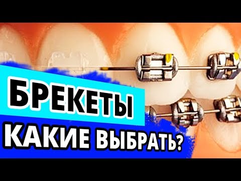 Видео: Какие выбрать брекеты? Совет ортодонта из Москвы