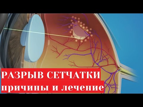 Видео: Разрыв сетчатки глаза - причины и лечение (лазерная коагуляция)