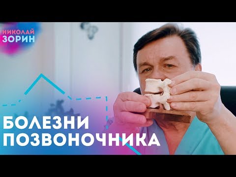 Видео: Что такое деформирующий спондилез, остеохондроз, спондилоартроз, фасеточный синдром, грыжа Шморля