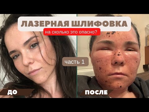 Видео: ЛАЗЕРНАЯ ШЛИФОВКА, моя история. Лазерная шлифовка лица CO2 лазером (ЧАСТЬ 1).