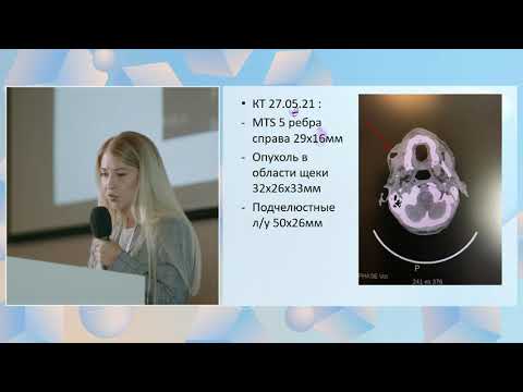 Видео: Клинический случай лечения рецидивирующего плоскоклеточного рака слизистой полости рта -Стативко О А