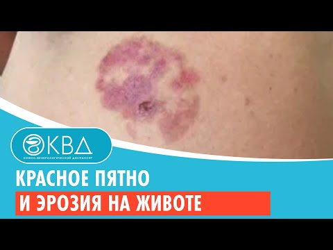 Видео: 😟 Красное пятно и эрозия на животе. Клинический случай №805