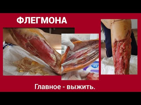 Видео: Флегмона. Главное - выжить.