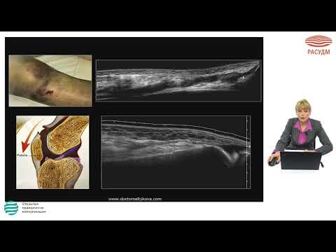 Видео: Ультразвуковое исследование коленного сустава