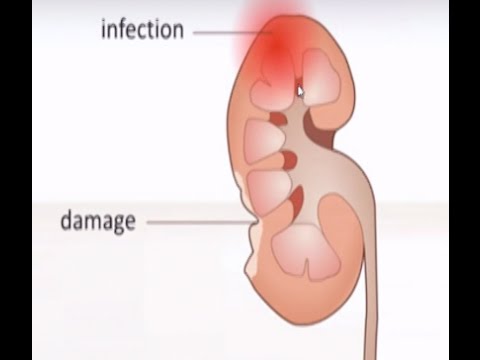 Видео: Бъбречна недостатъчност - клинична изява, диагностика и лечение